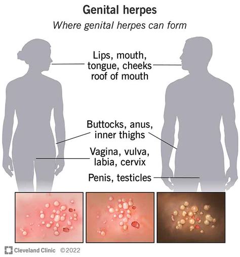 Genital Herpes Symptoms: What to Look For